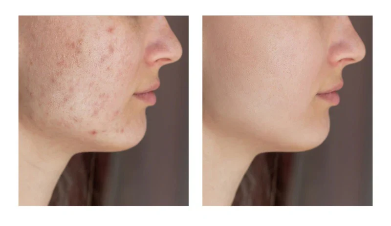 Acne Serum - Image 3